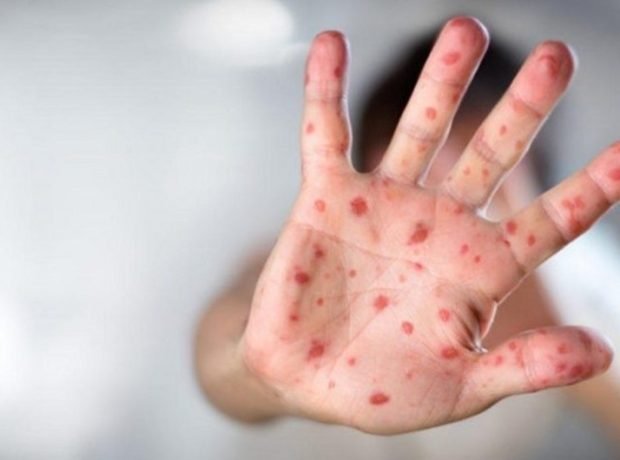 TƏCİLİ! Azərbaycanda qızılca ilə bağlı ŞOK AÇIQLAMA TƏCİLİ! Azərbaycanda qızılca ilə bağlı ŞOK AÇIQLAMA